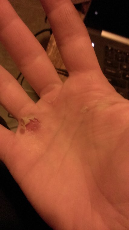 blisters right hand