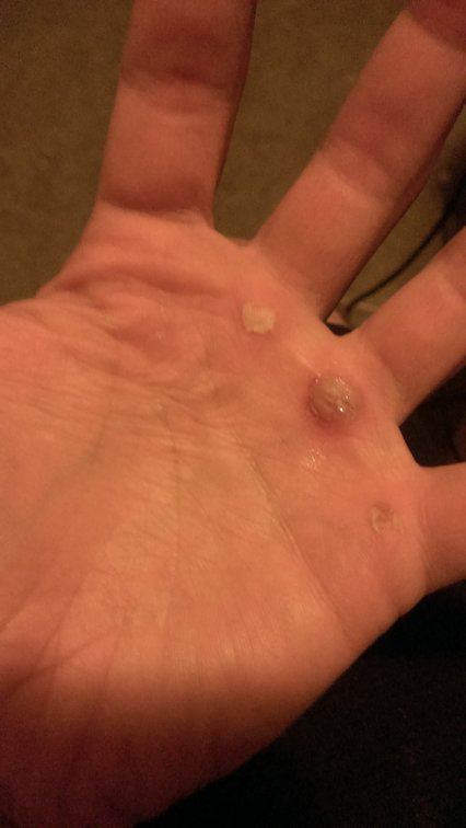 blisters left hand